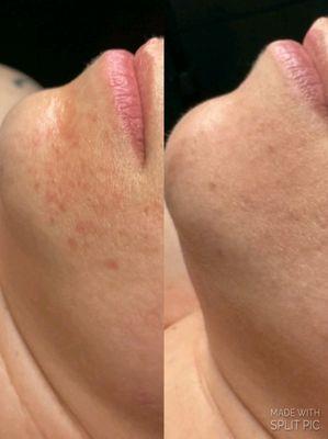 Before and after chemical peel