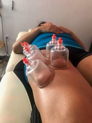 Addressing leg and knee pain with cupping therapy.