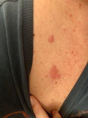 Bed bugs but no refund.