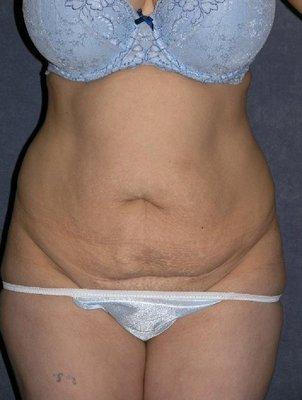 #1464 ABDOMINOPLASTY -  45 YEAR OLD, HISPANIC FEMALE, PRE-OP