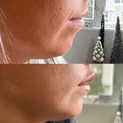 Lip & chin filler for facial balancing