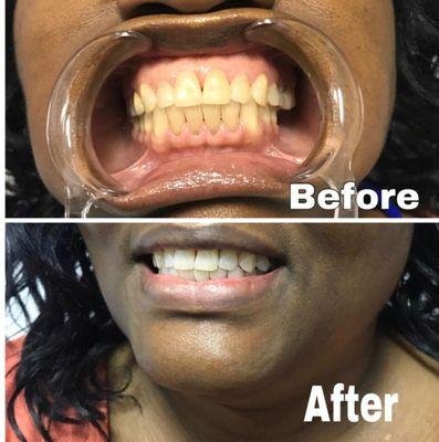 Befor and After Pictures Teeth Whitening