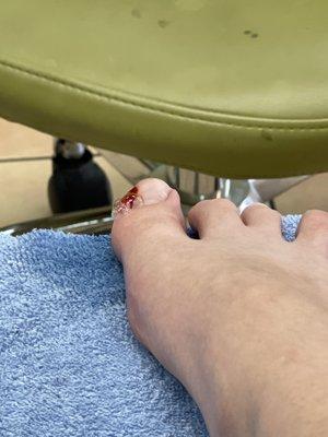 Injured toe