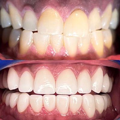 Brand new smile in 2 weeks by Dr. Annie