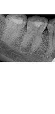 X-ray taken after Dr. Son "repaired" my old fillings, you can clearly see a hole in the second from back molar which left my nerve exposed.