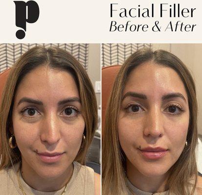 Dermal Filler by Priya