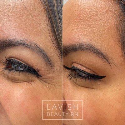 Botox for crows feet before and after