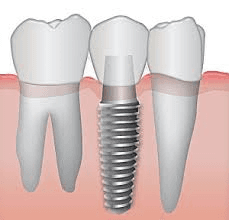 Interested in implants? Please call for a consultation.