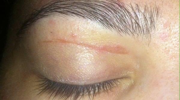 Second day, from the eyebrow wax. Still swollen and STILL sensitive to light!