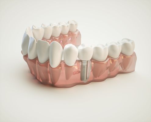 Dental implants are titanium tooth roots that are inserted into the jaw bone. After the area heals, a crown is placed over it...