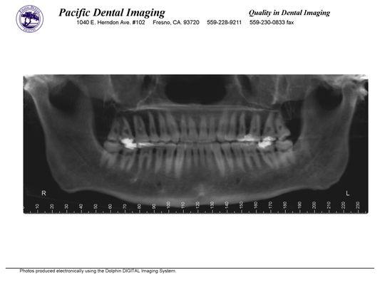 Panoramic X-Ray