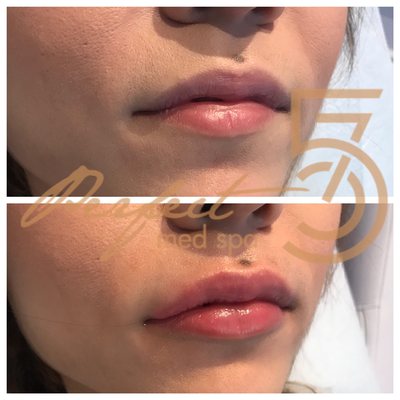 Lips injections