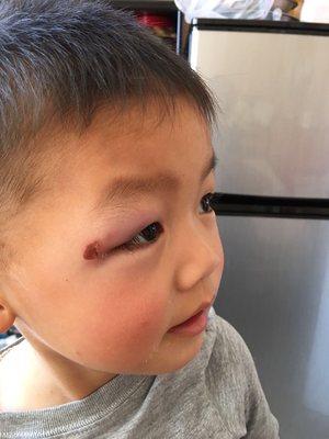 The left eye got swollen and you still can see the mark of blood. My cousin is only 3 years old.