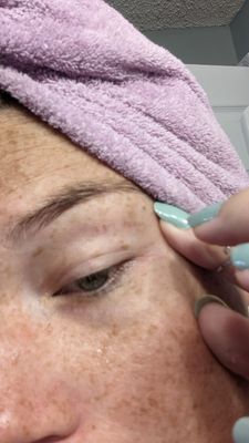 Threading wound above eye