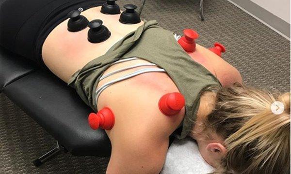 Cupping Treatment