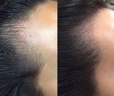 Scalp Micropigmentation