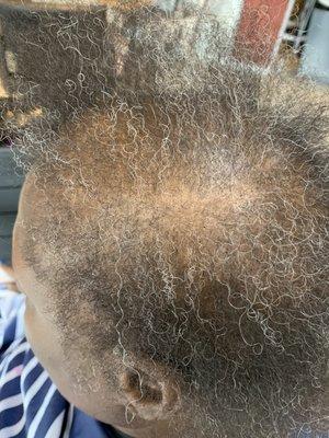 Alopecia alternative