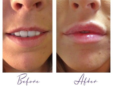 Juvederm Before and After by Daiquiri R.N.