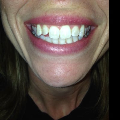 DaVinci teeth whitening results! It only took 20 minutes to get rid of this lovely gals surface stains!