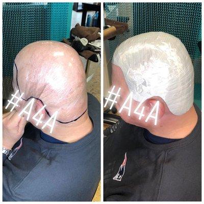 Custom mold making for men's unit- Alopecia Totalis