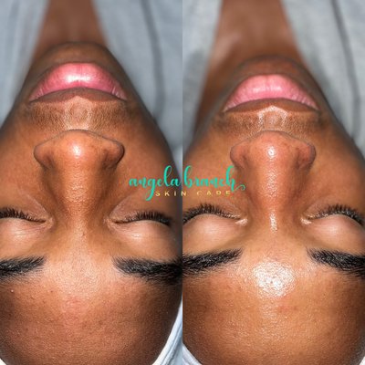 Purifying Teen Facial with Pore Extractions