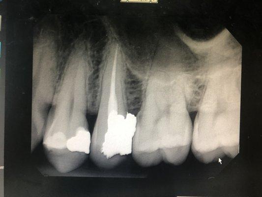 Root Canal