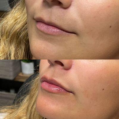 1 ml lip filler, Juvederm Ultra