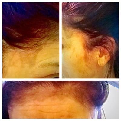 Dye stains on my mom's face after visit to CC Bella salon