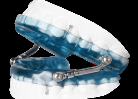 Oral Appliance for OSA