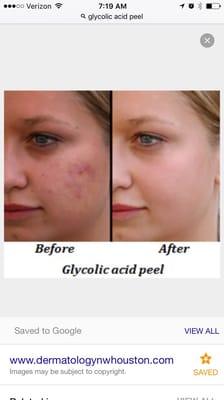 Glycolic Acid peels available