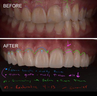 Digital smile design demonstrates smile makeovers before treatment.