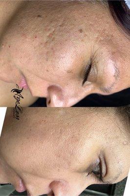 Acne scar correction using fractional RF Microneedling