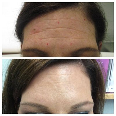 Botox Cosmetic Treatment