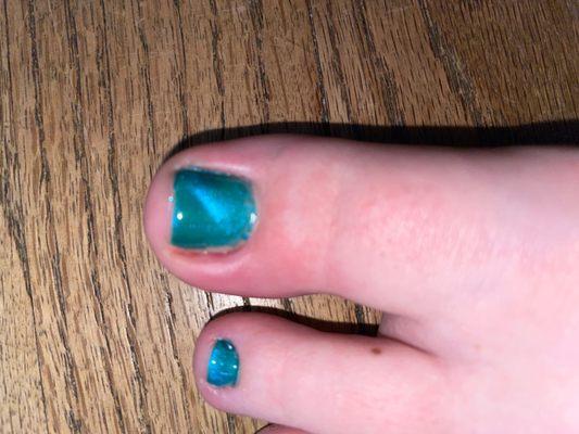 My infected toe... and you can see that they didn't even paint my whole toenail... also, the shiny inside the crease is pus.