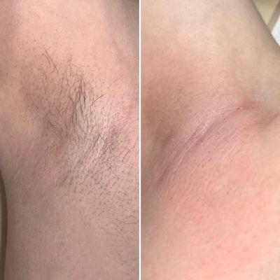 Before and after of an underarm wax