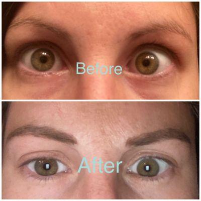 Eyebrows before microblading and after