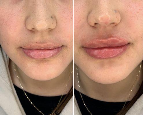 Lip refining