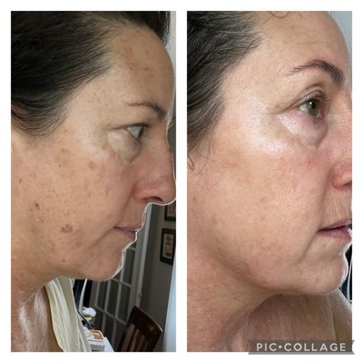 Results after one BBL treatment to help with the discoloration from sun damage on my face. PHENOMENAL! Marla at AesthestiSpa rocks!