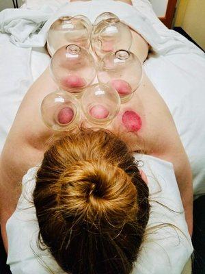 Cupping for back pain