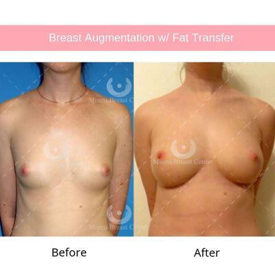 Before and after breast augmentation with fat transfer.