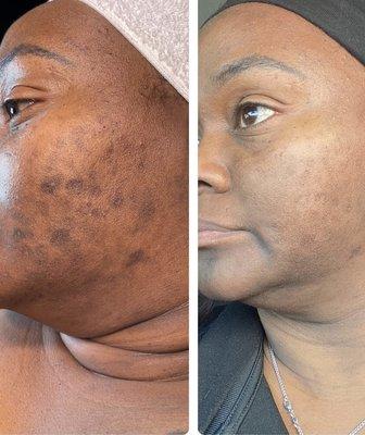 Hyperpigmentation treatment