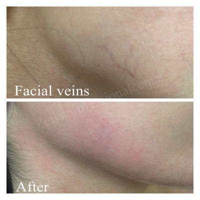 Facial veins