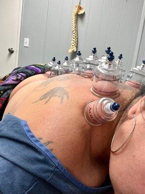 Cupping to help release the toxins, reduce pain and help with circulation