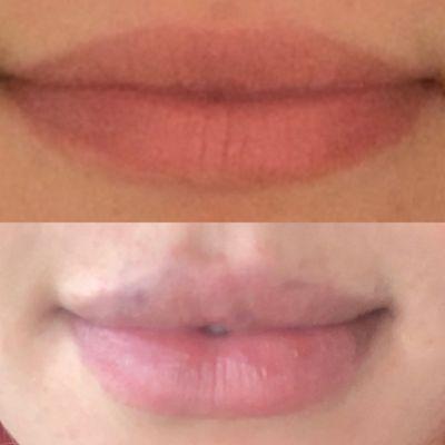 Enhance your lips with our line of Fillers!