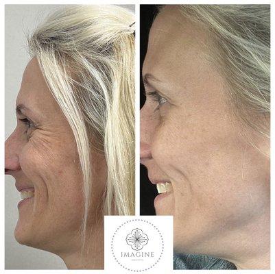 This lovely client had her first ever Neurotoxin Injections one week ago! 
 Here is her Before & After!