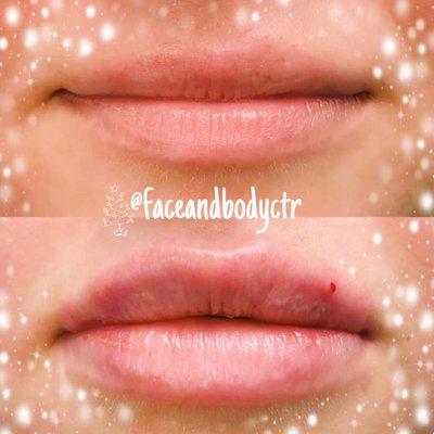 1ml lip plump at The Face & Body Spa