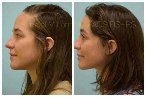 This 30-year-old female is shown before and six months after a hair transplant into her hairline to lower her hairline, as she was born with