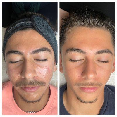 Acne facial