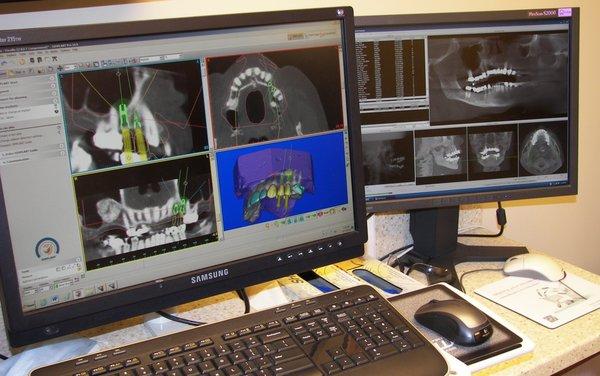 3D guided implant planning and placement