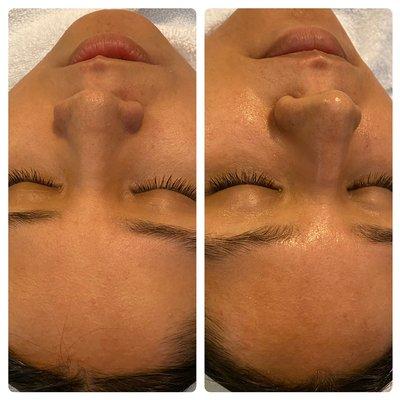 Before and after Custom Facial